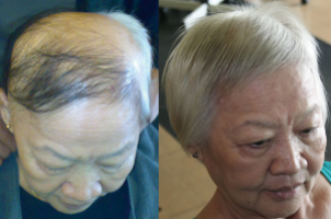 奶奶掉髮后，每天都用「这个」洗头，没想到头髮居然慢慢长回来了．．．真的超神奇，你一试就知道！